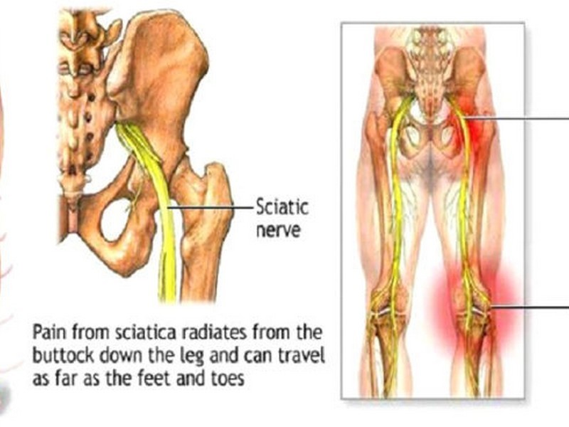 Sciatic Nerve Pain Southport Chiropractic Near Me